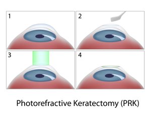 prk infographic