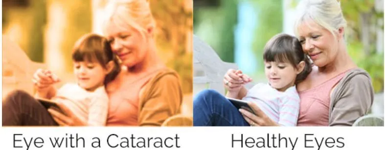 cataract vision example
