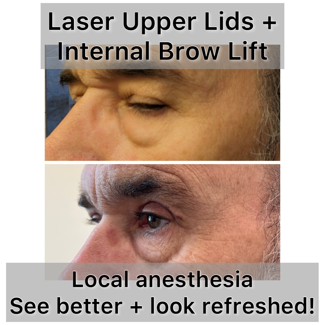 Brow Lift Before & After Gallery - Patient 389360 - Image 1