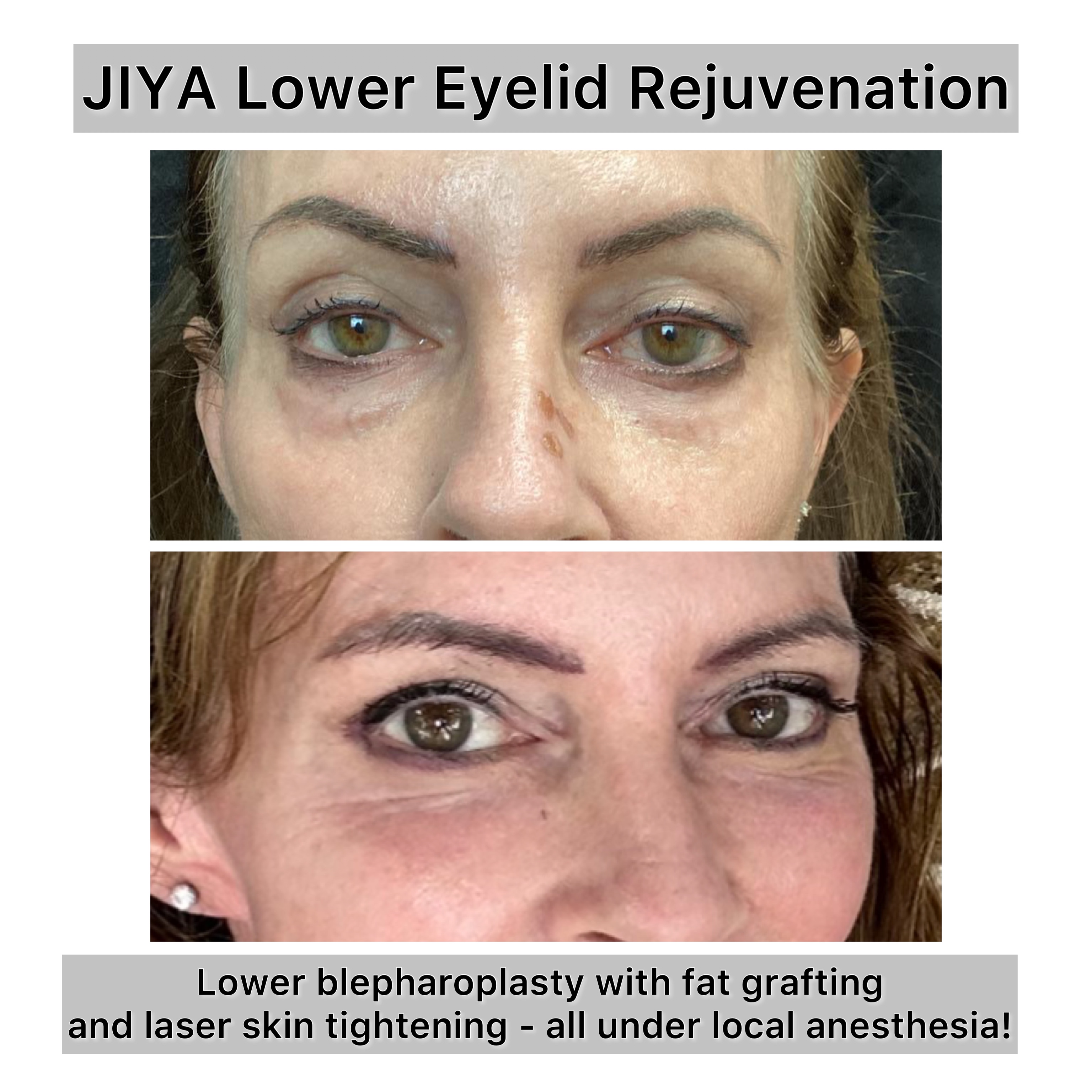 Lower Blepharoplasty Before & After Gallery - Patient 224084 - Image 1