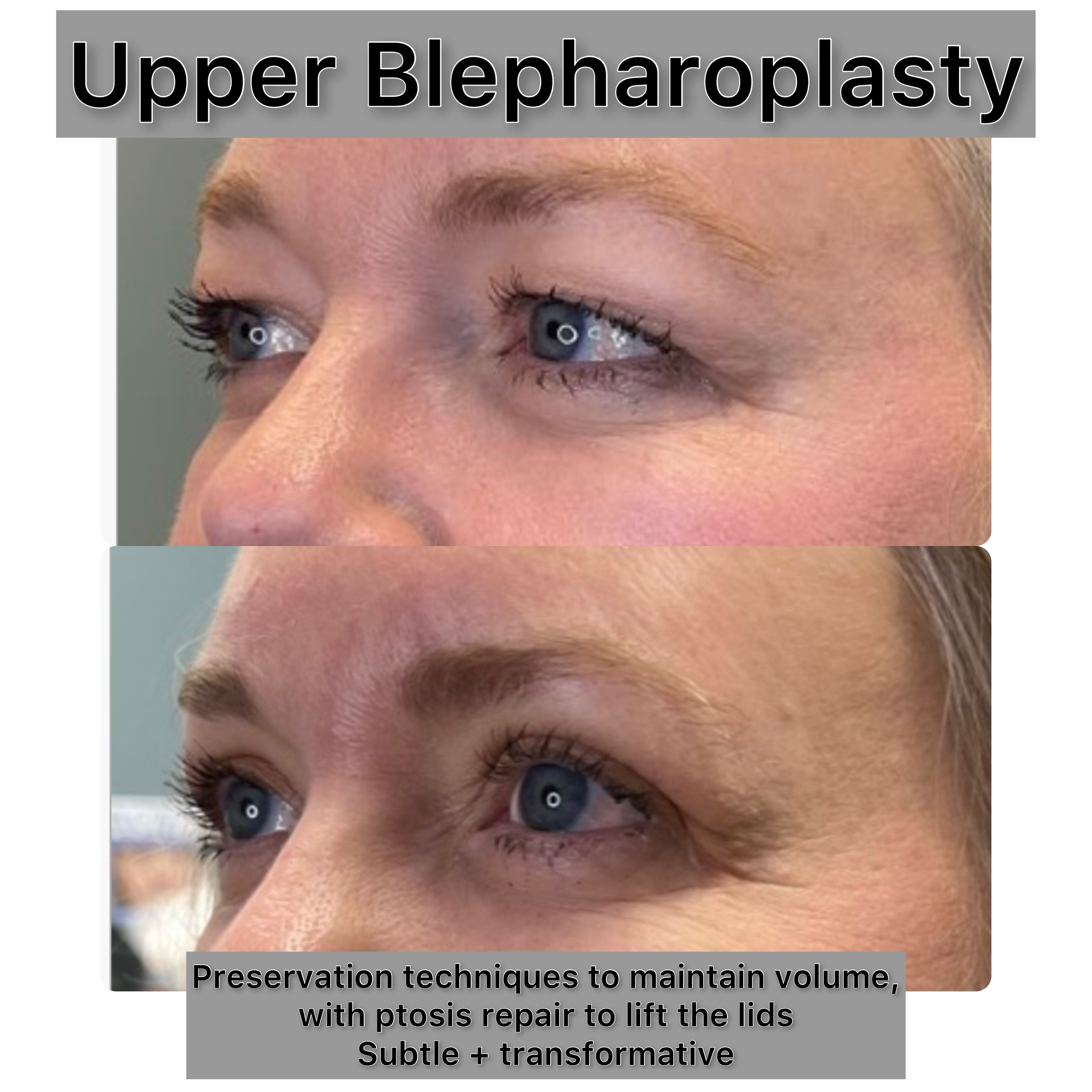 Upper Blepharoplasty Before & After Gallery - Patient 320225 - Image 1
