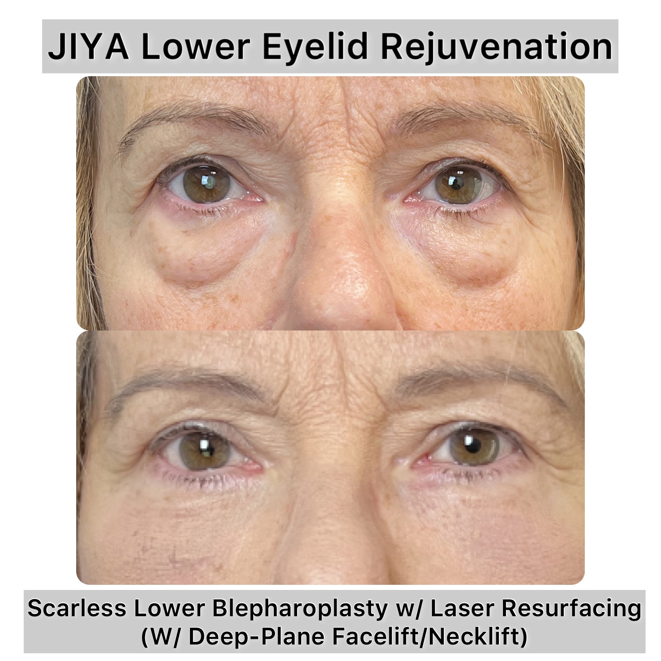 Lower Blepharoplasty Before & After Gallery - Patient 170503 - Image 1