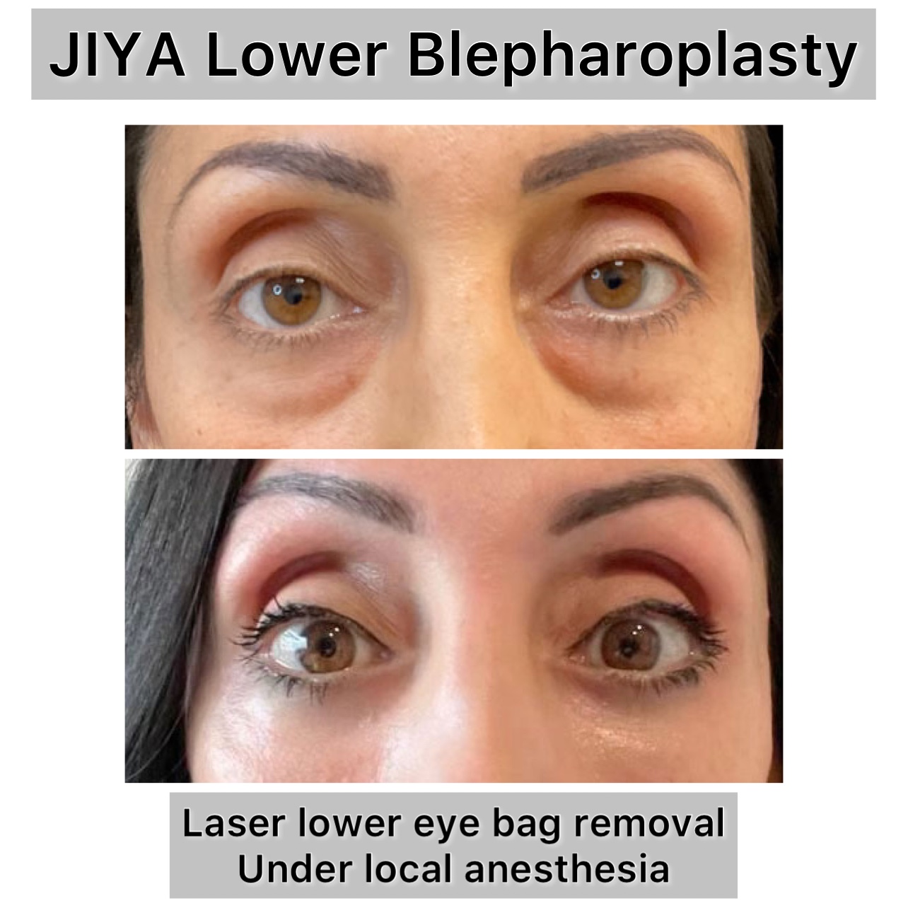 Lower Blepharoplasty Before & After Gallery - Patient 192380 - Image 1
