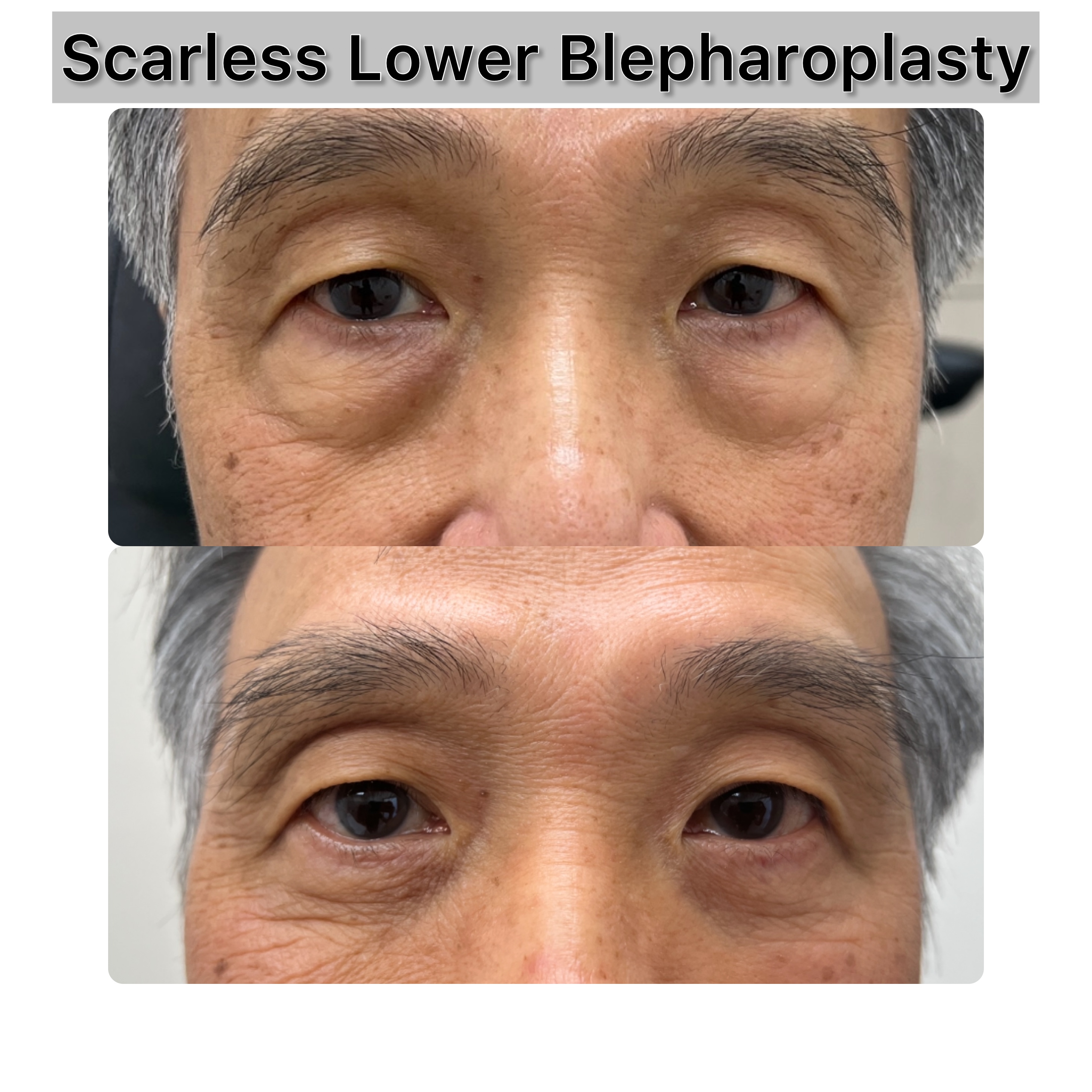 Lower Blepharoplasty Before & After Gallery - Patient 271220 - Image 1