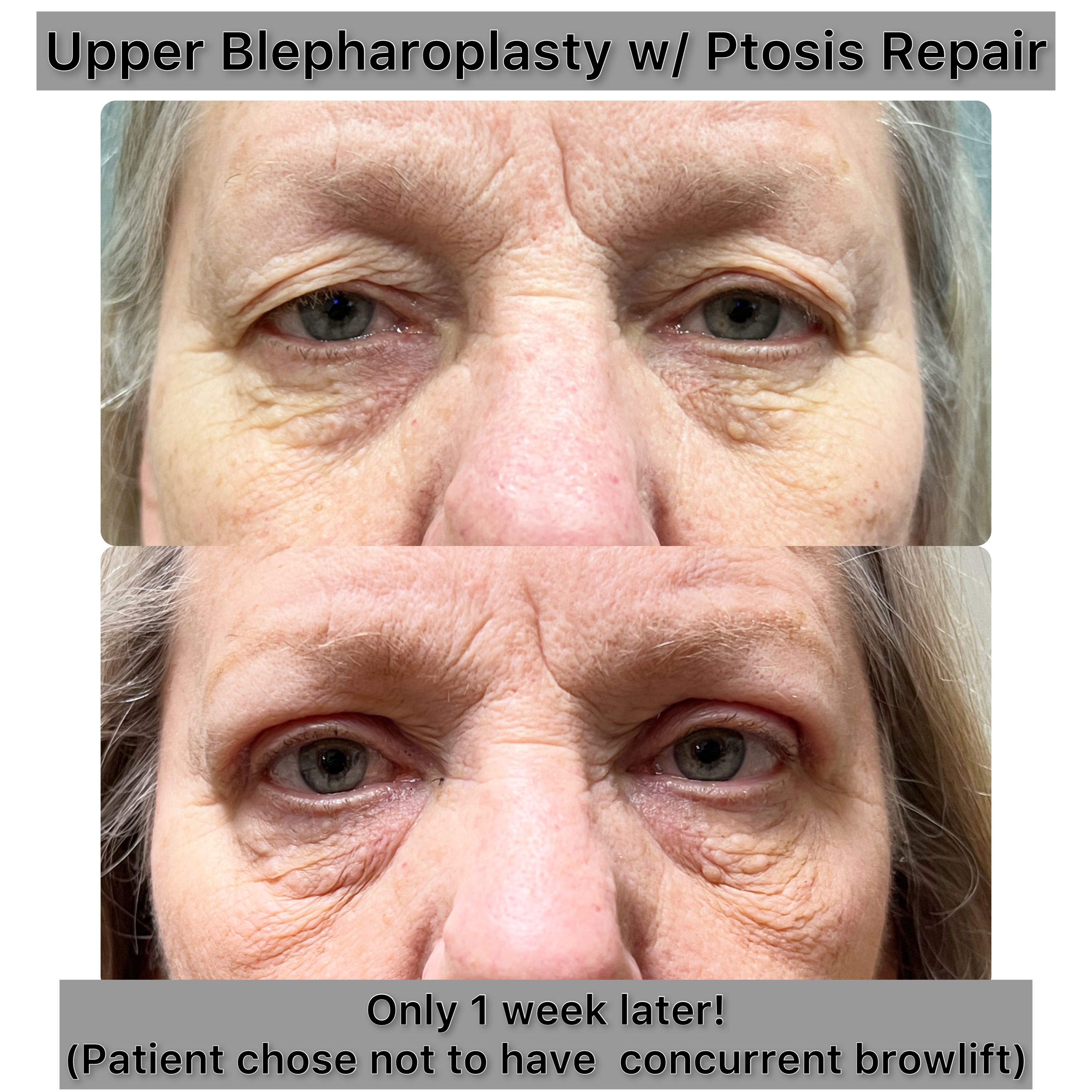 Ptosis Repair Before & After Gallery - Patient 376928 - Image 1