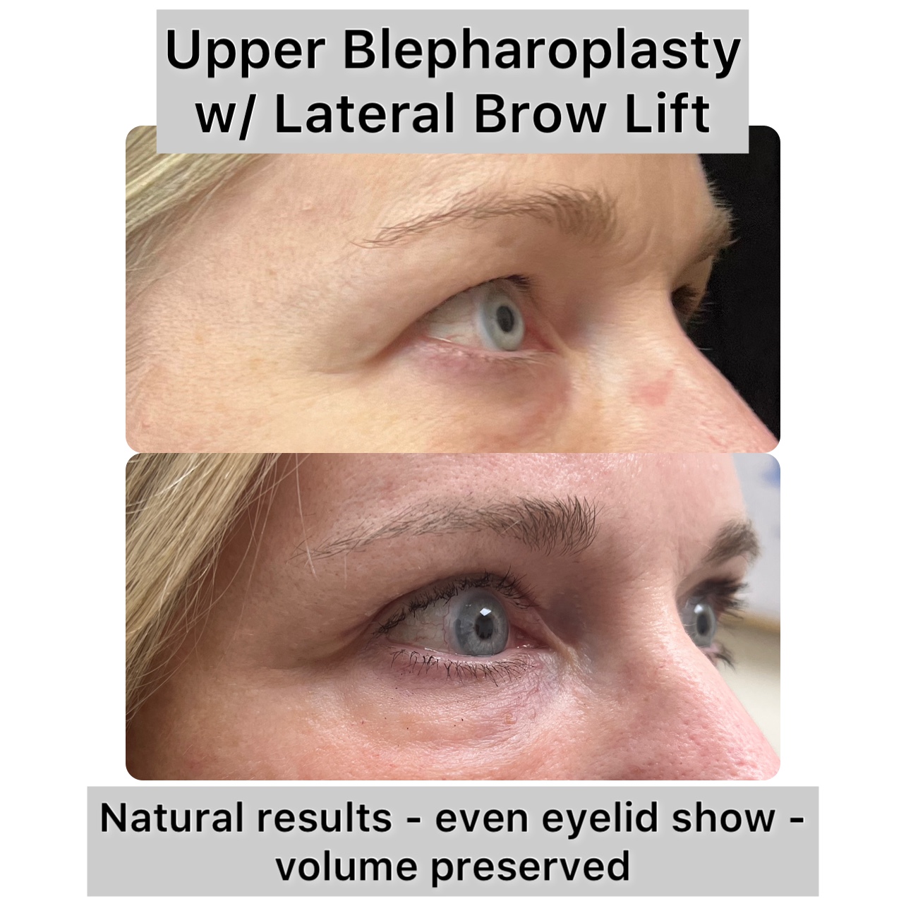 Brow Lift Before & After Gallery - Patient 292981 - Image 1