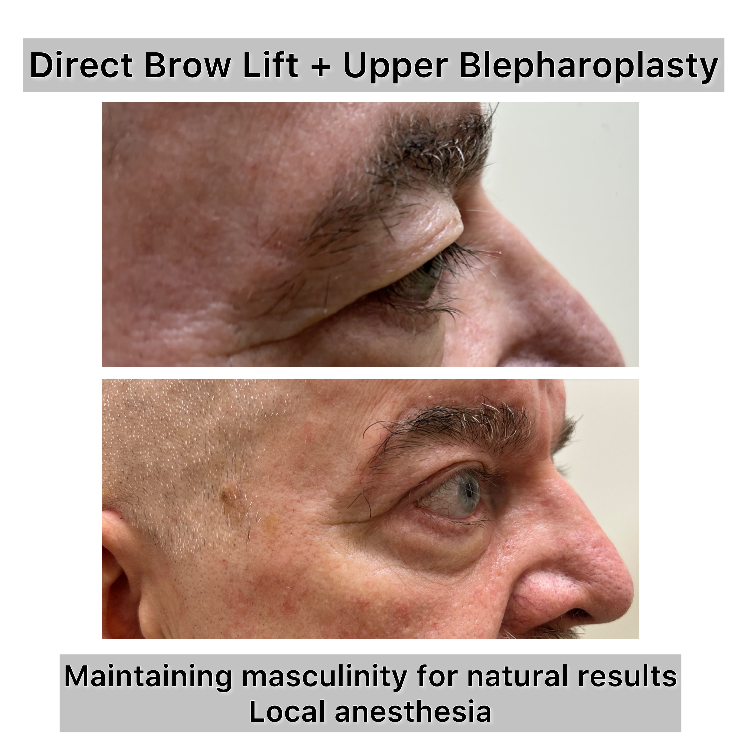 Brow Lift Before & After Gallery - Patient 982389 - Image 1