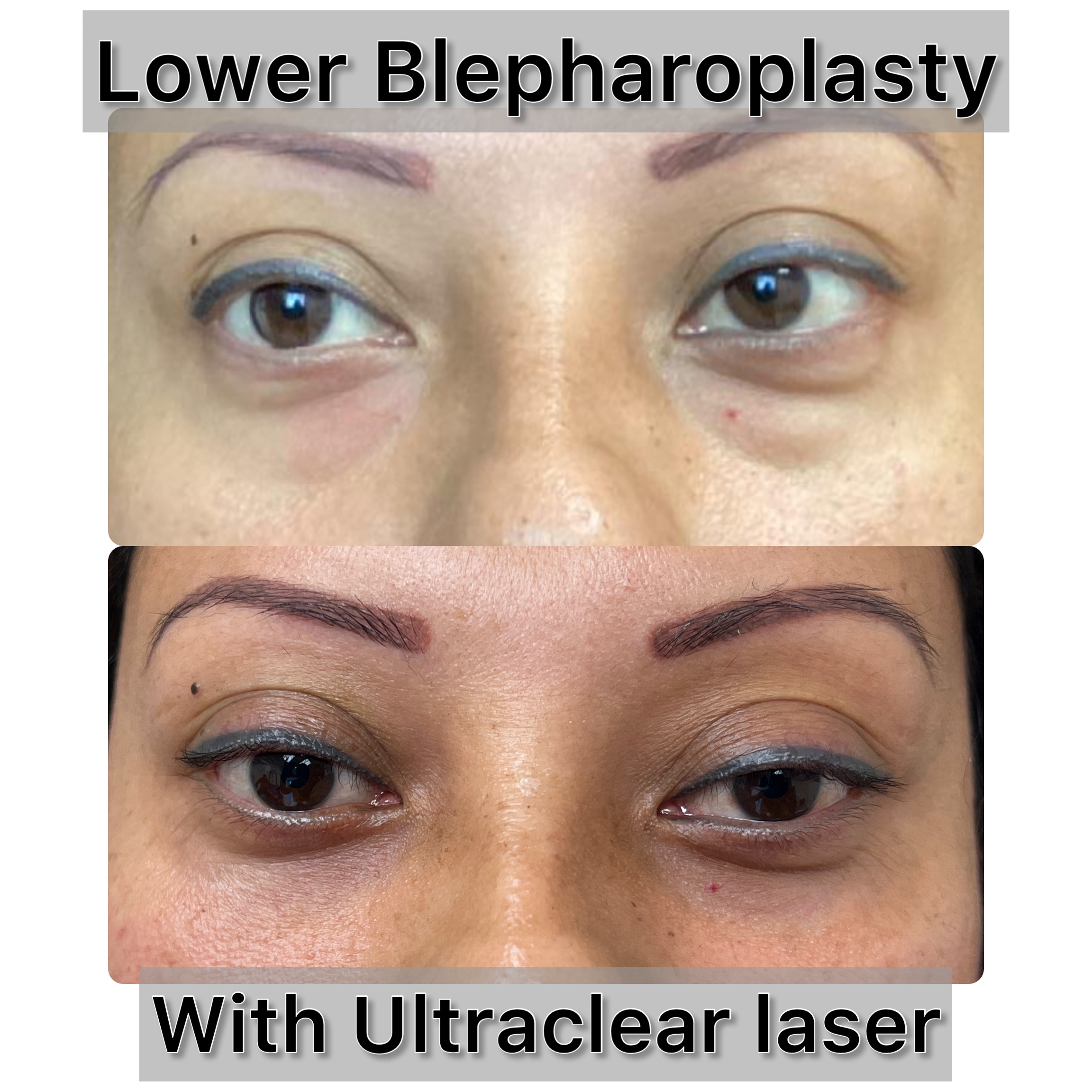 Lower Blepharoplasty Before & After Gallery - Patient 256475 - Image 1