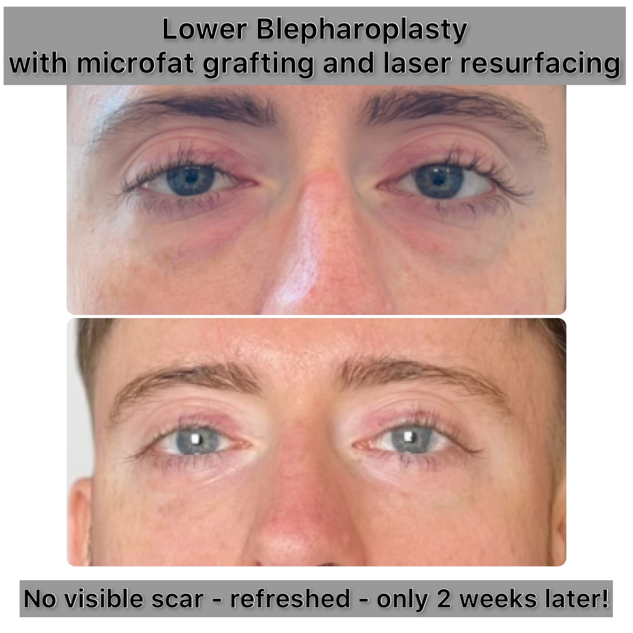 Lower Blepharoplasty Before & After Gallery - Patient 324007 - Image 1