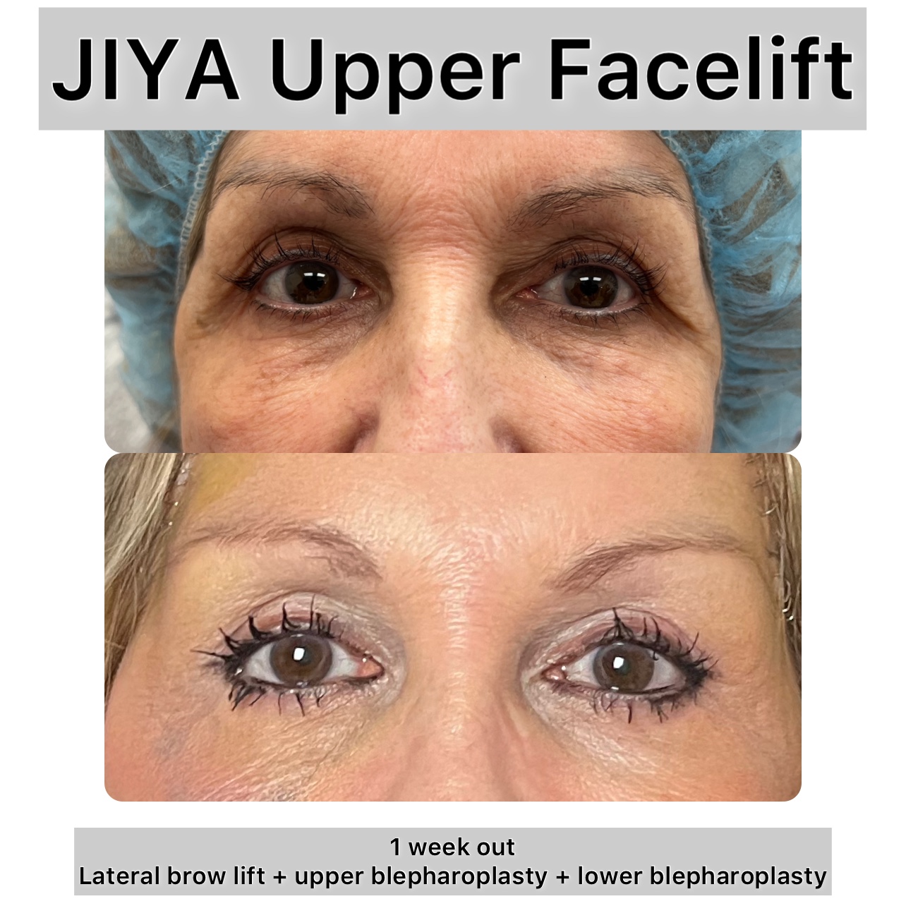 Upper and Lower Blepharoplasty Before & After Gallery - Patient 303479 - Image 1