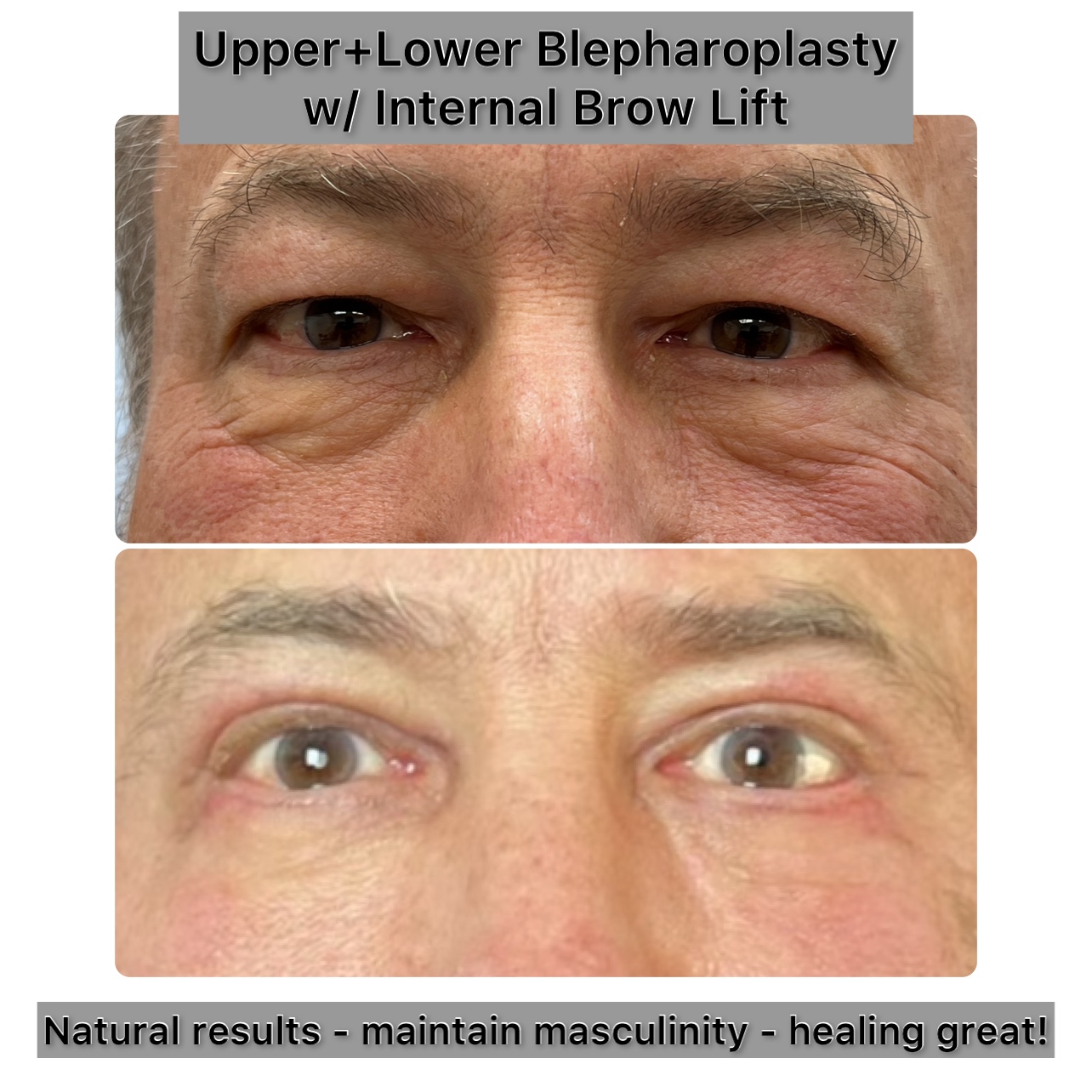 Upper and Lower Blepharoplasty Before & After Gallery - Patient 303803 - Image 1