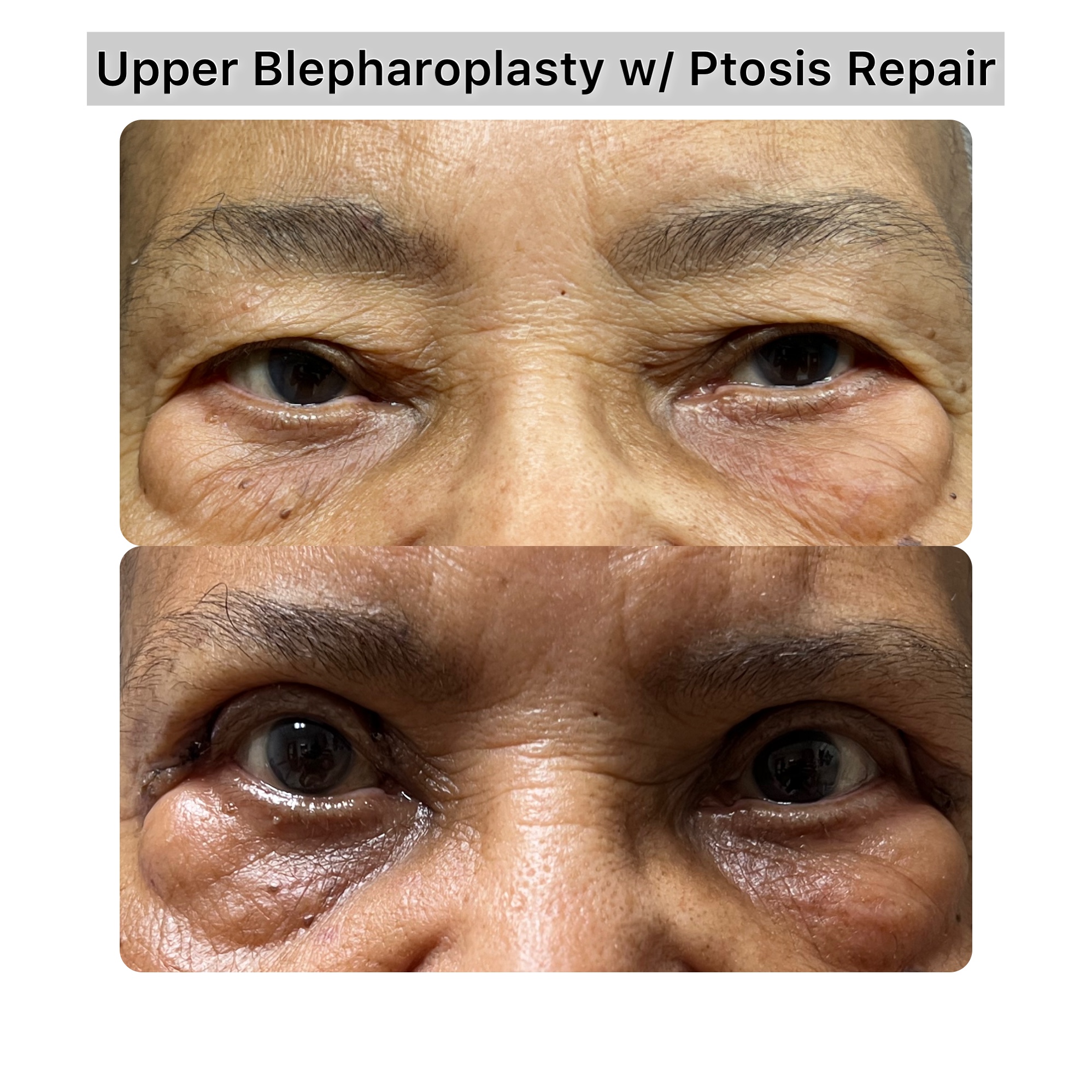 Brow Lift Before & After Gallery - Patient 278493 - Image 1