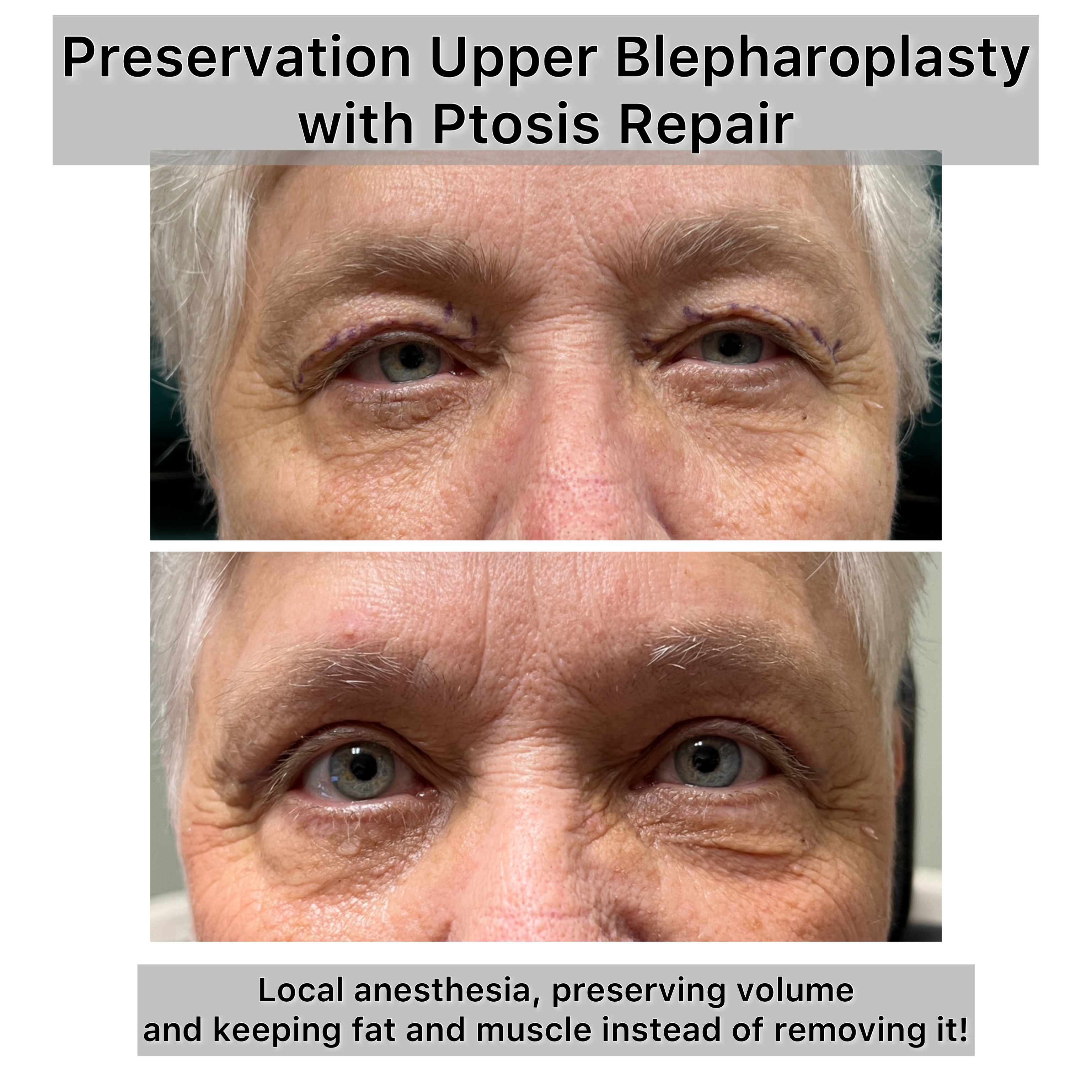 Upper Blepharoplasty Before & After Gallery - Patient 116706 - Image 1