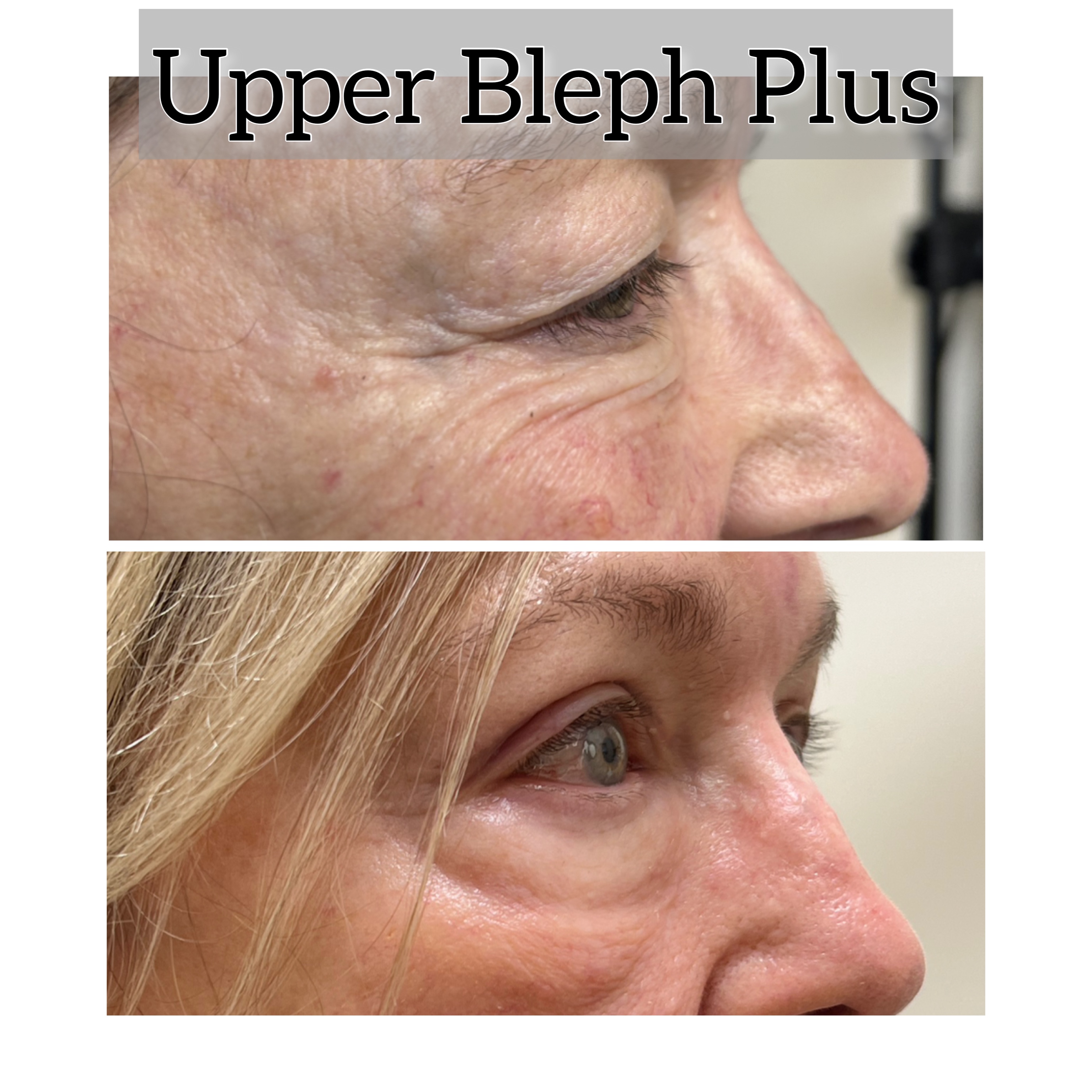 Upper Blepharoplasty Before & After Gallery - Patient 815263 - Image 1