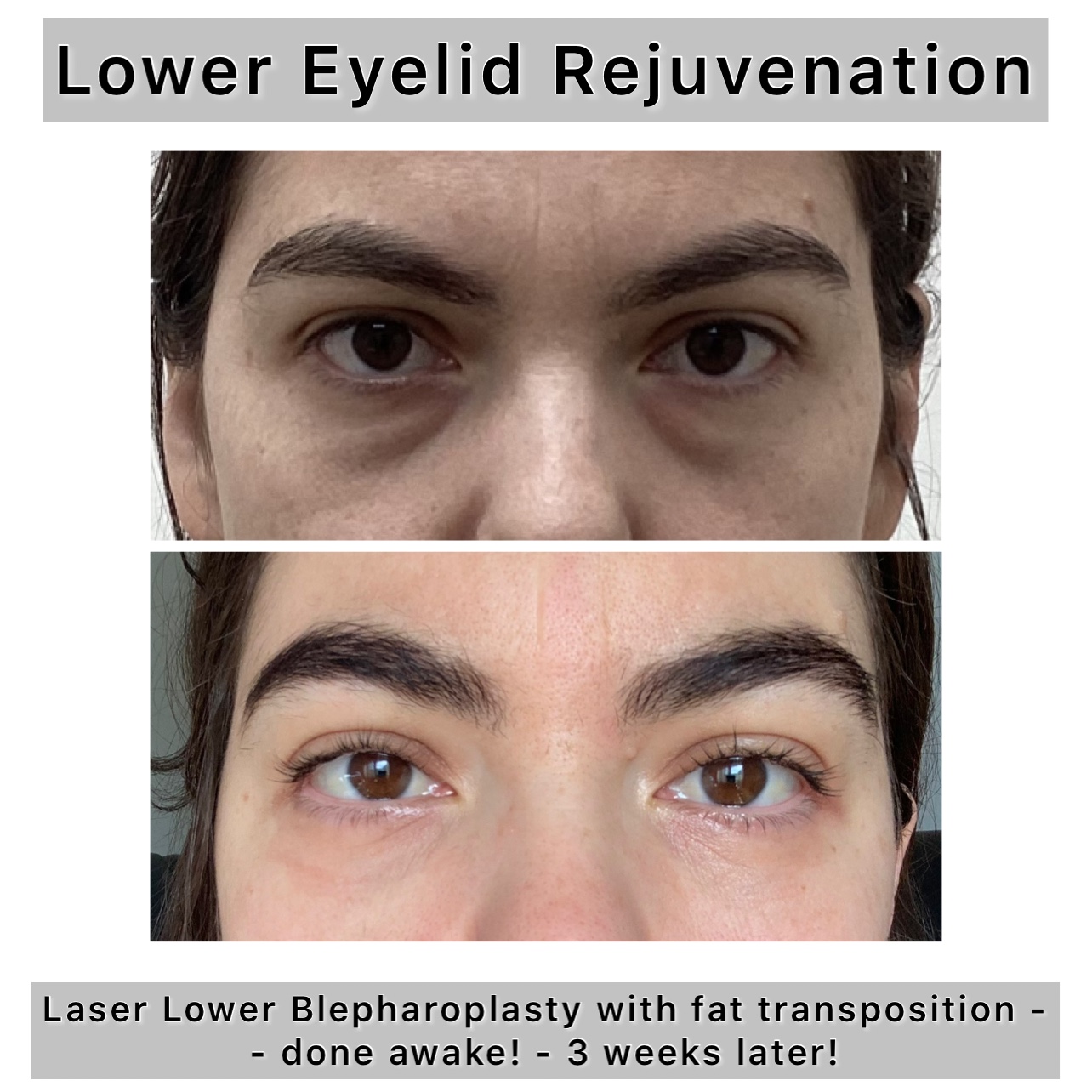 Lower Blepharoplasty Before & After Gallery - Patient 122054 - Image 1