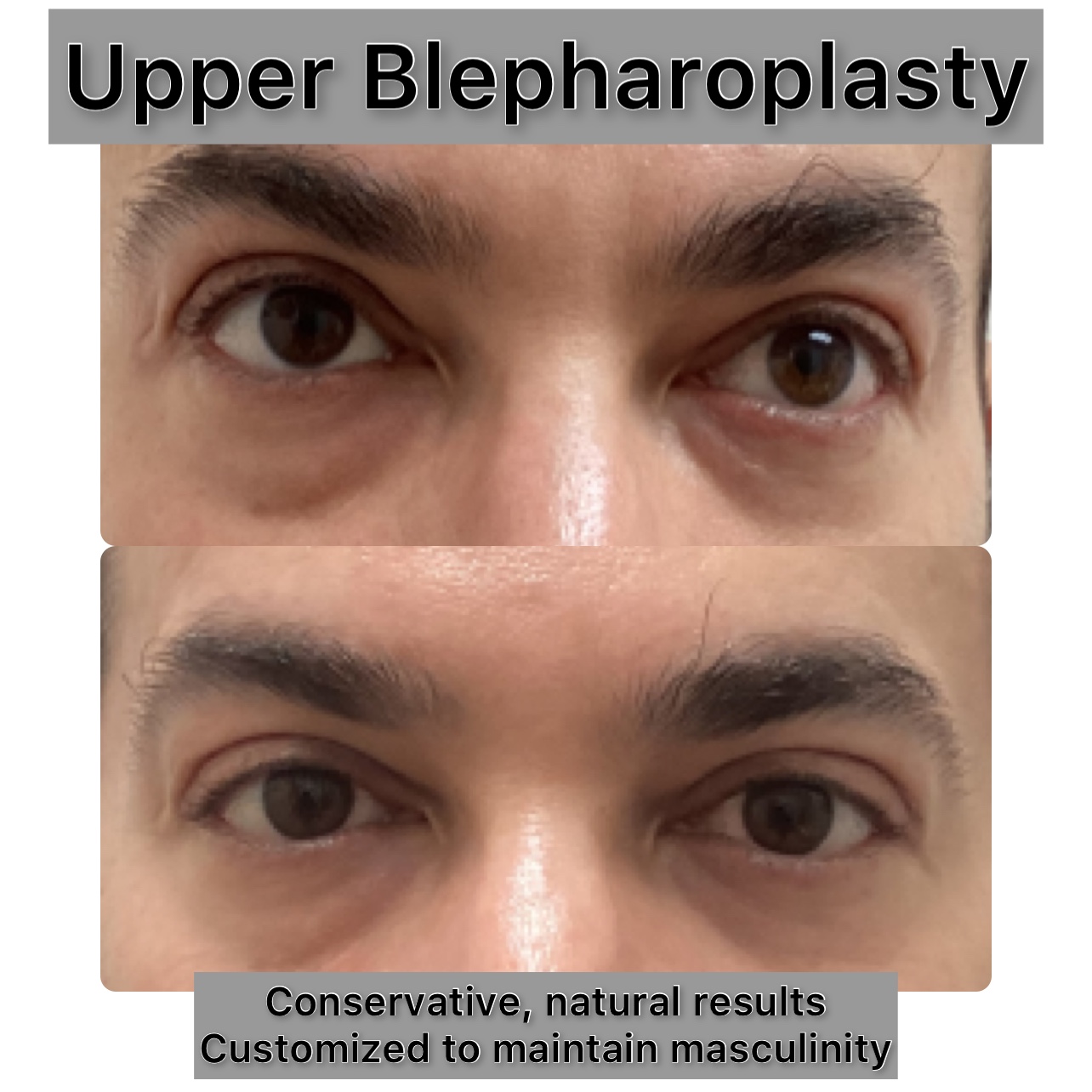 Upper Blepharoplasty Before & After Gallery - Patient 181696 - Image 1