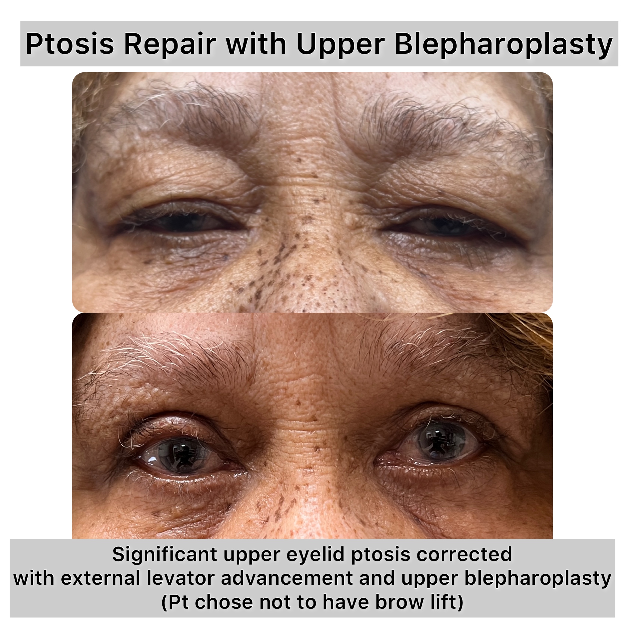 Ptosis Repair Before & After Gallery - Patient 263158 - Image 1