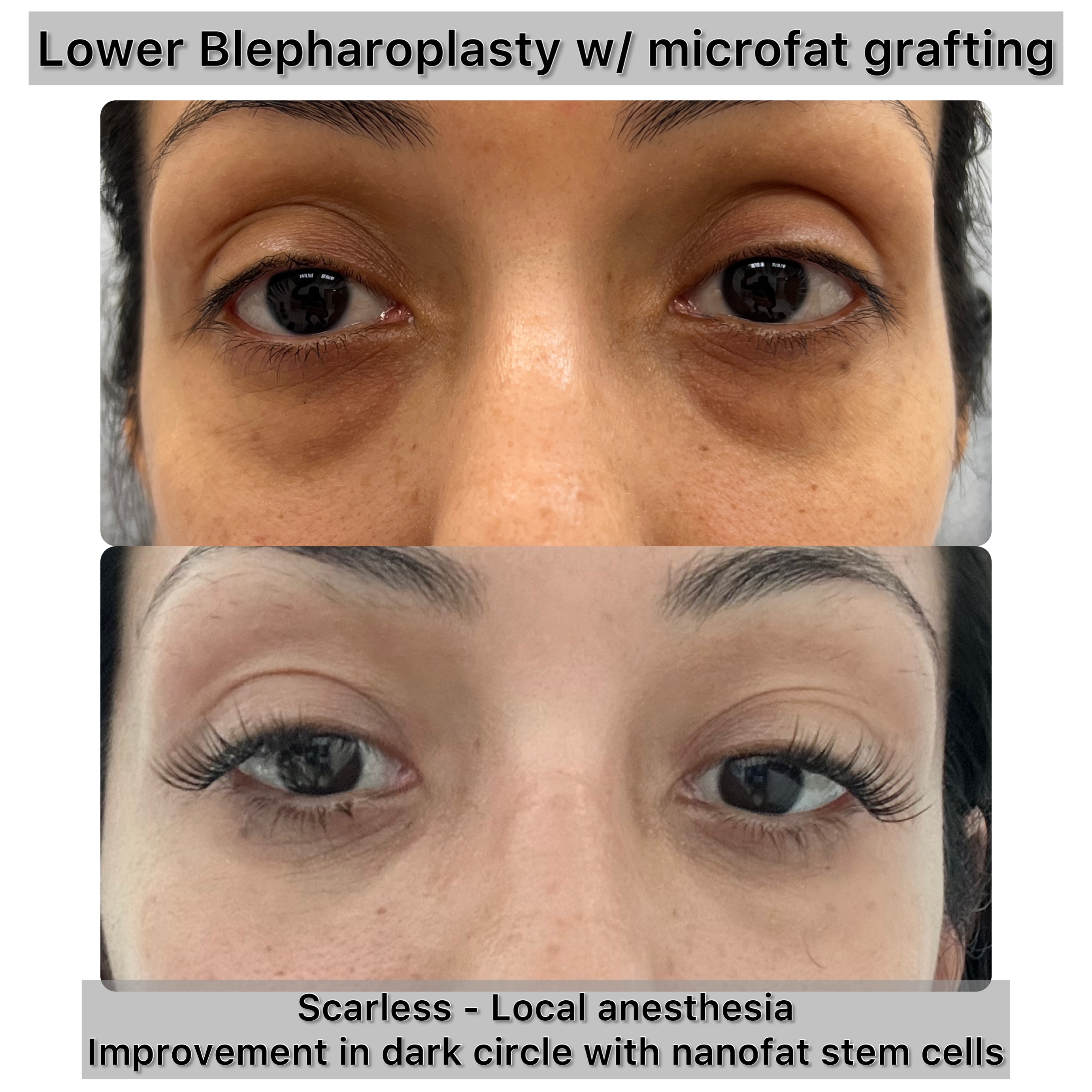 Lower Blepharoplasty Before & After Gallery - Patient 134954 - Image 1