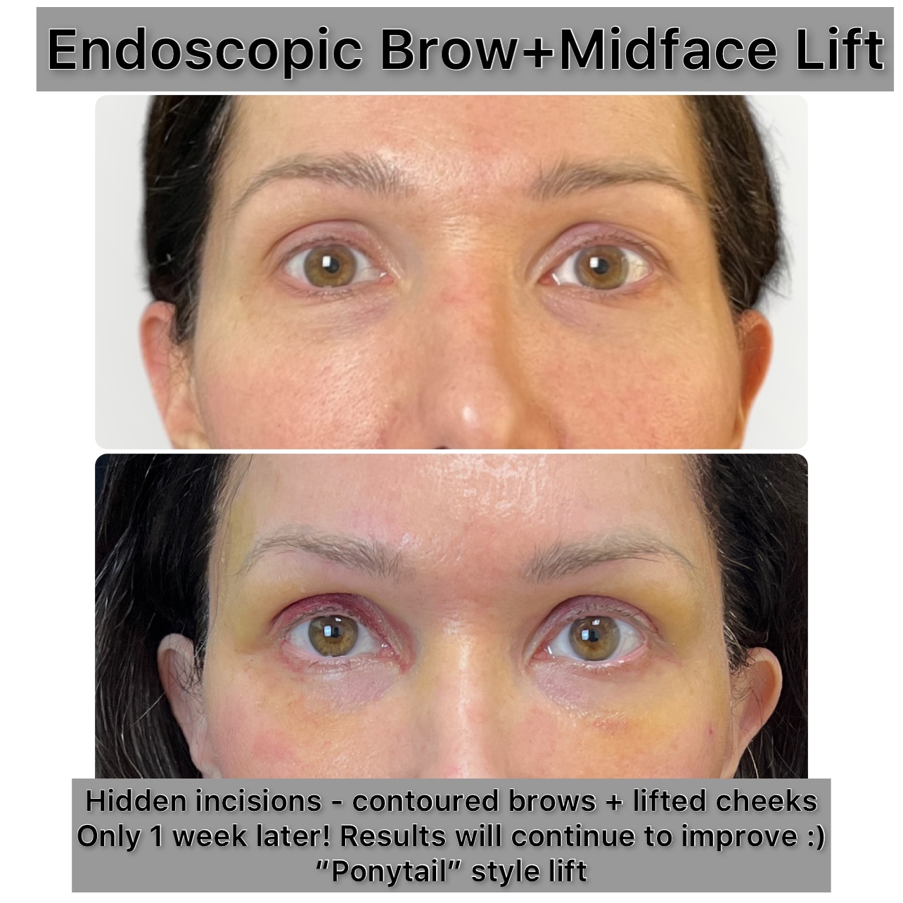 Brow Lift Before & After Gallery - Patient 267575 - Image 1
