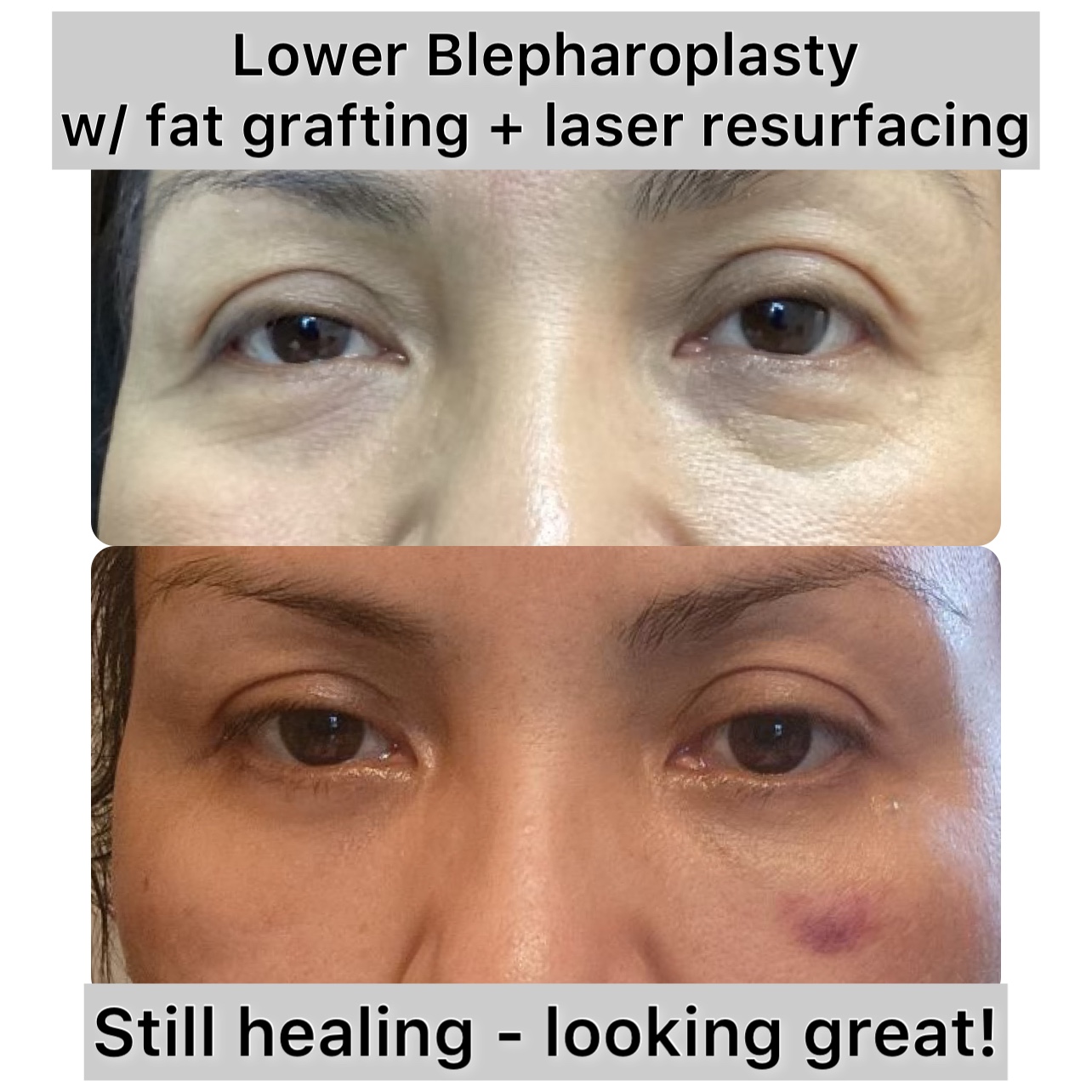 Lower Blepharoplasty Before & After Gallery - Patient 163464 - Image 1