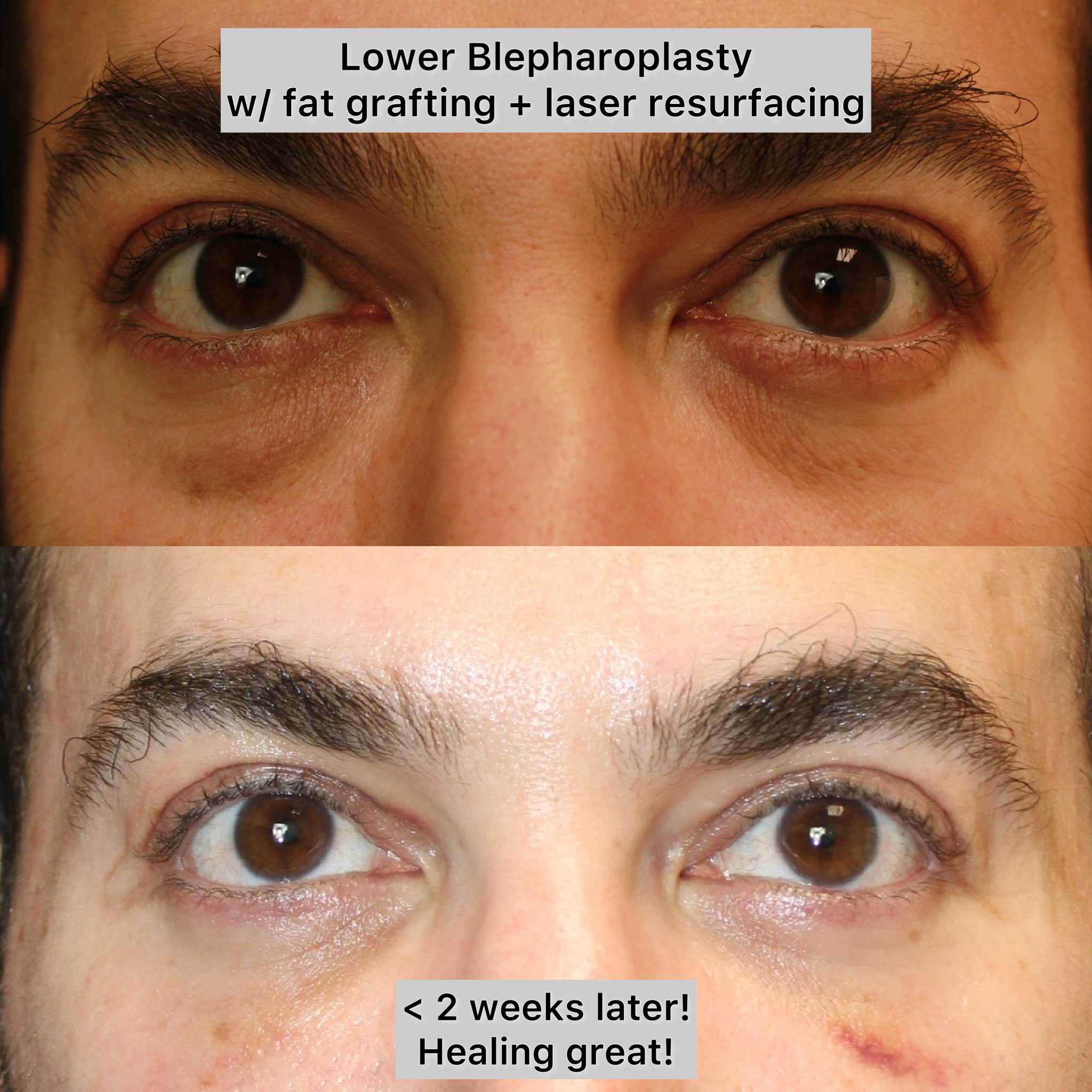 Fat Grafting Before & After Gallery - Patient 400255 - Image 1