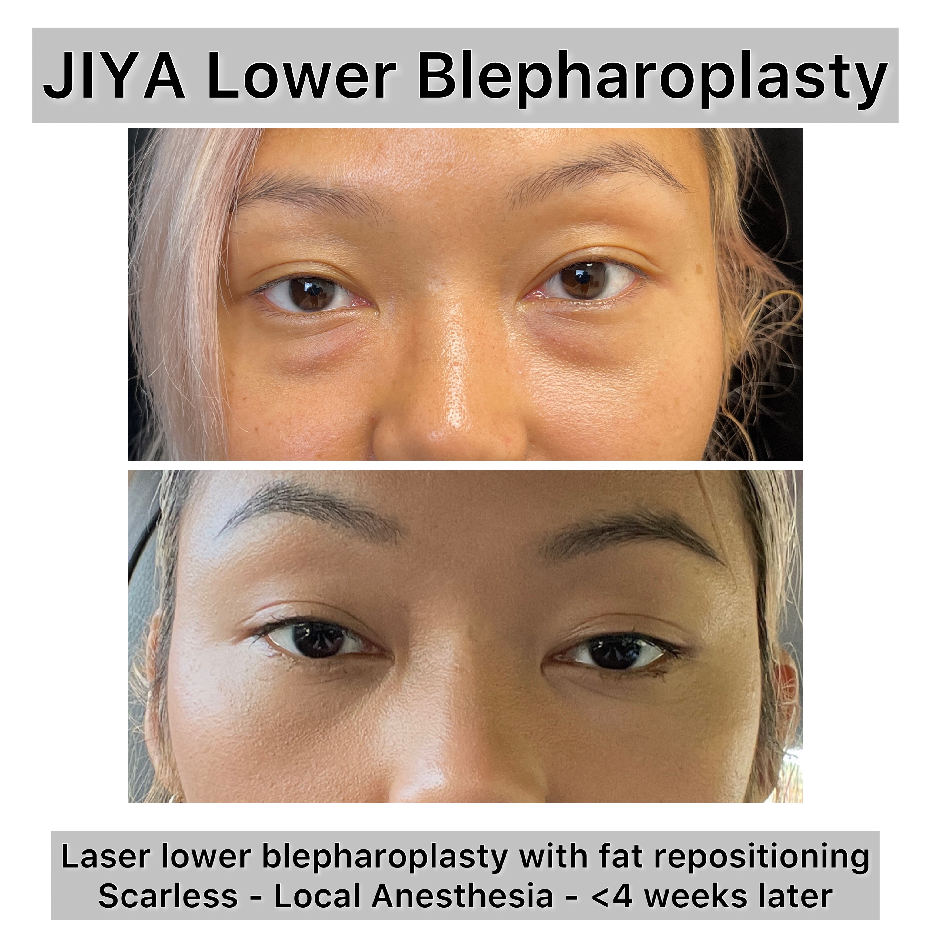 Lower Blepharoplasty Before & After Gallery - Patient 162886 - Image 1