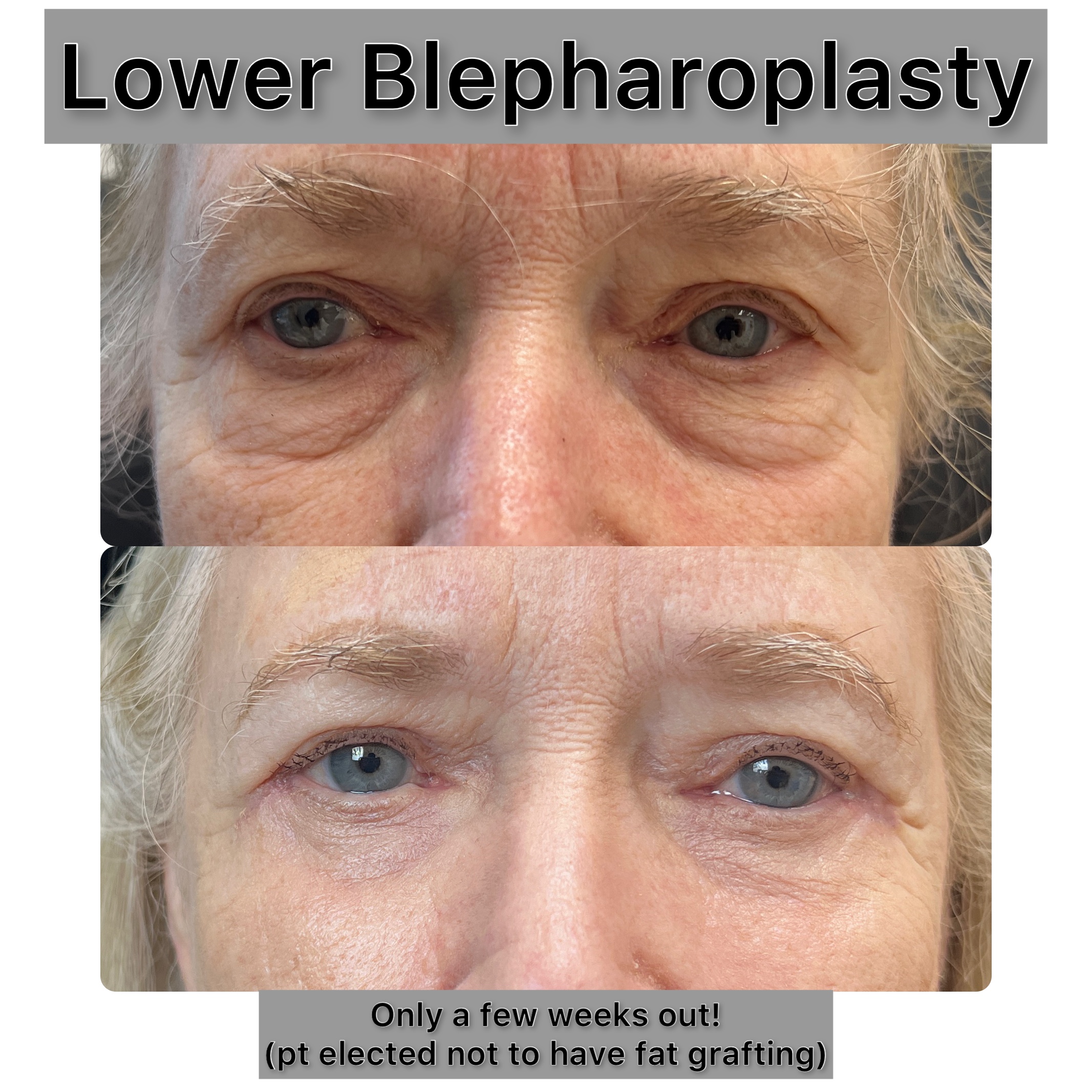 Lower Blepharoplasty Before & After Gallery - Patient 294181 - Image 1