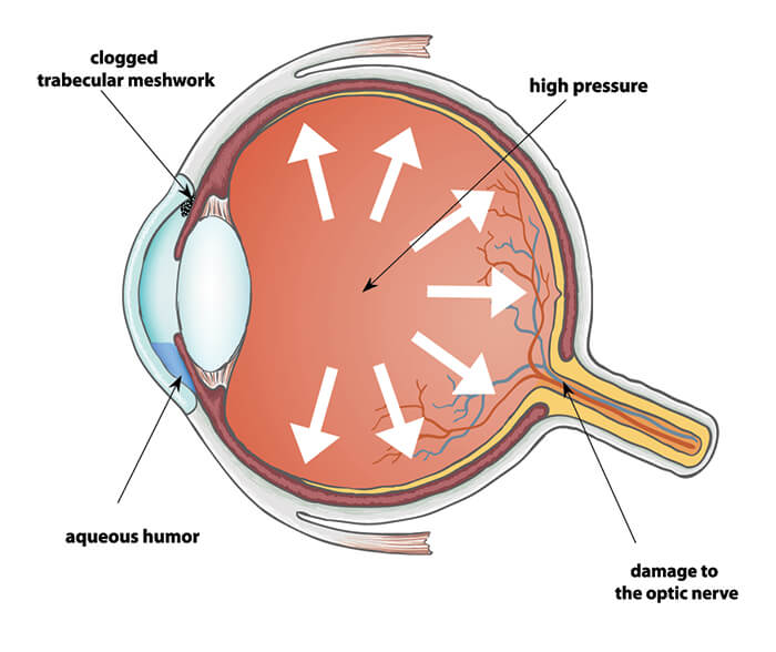 Glaucoma animation